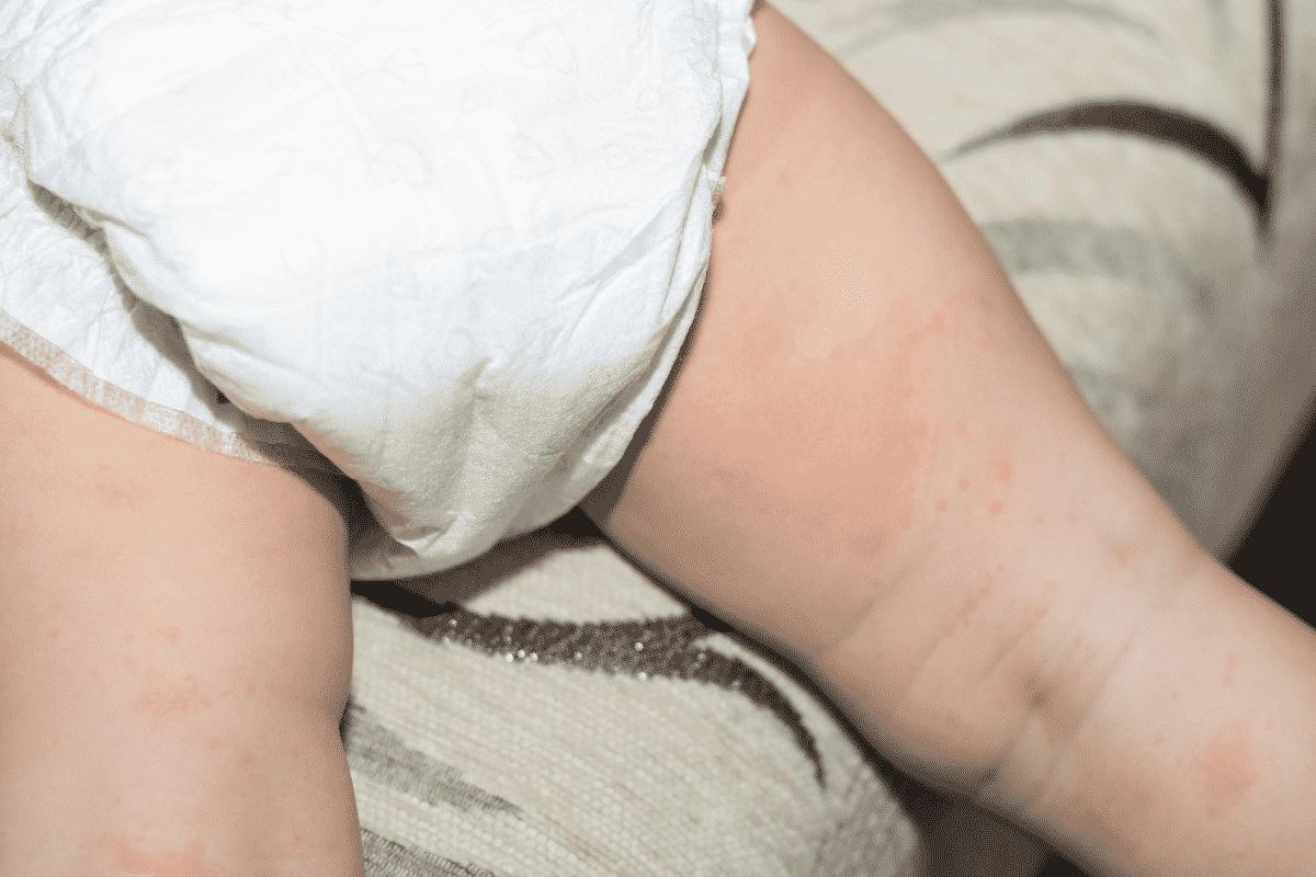 Diaper rash from food allergy or intolerance