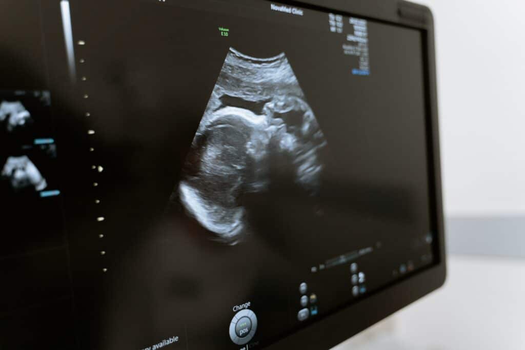 Ultrasound screen displaying a fetus